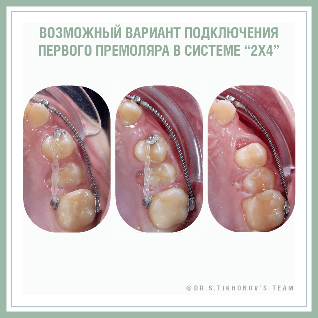 Непослушная 4-ка, или нюансы лечение частичной брекет-системой. - интересно  об ортодонтии, имплантации и протезировании зубов